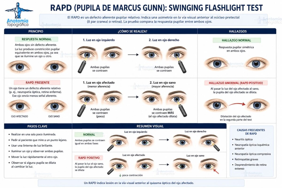 Nervio Óptico RAPD (pupila de Marcus Gunn): swinging flashlight test