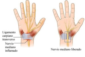 nervio mediano