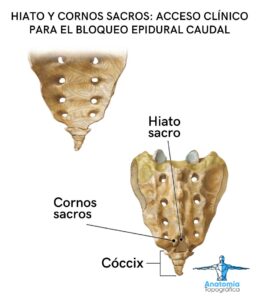 Hiato sacro entre los cuernos sacros: acceso para el bloqueo epidural caudal