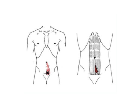 Músculo piramidal del abdomen Músculo piramidal del abdomen
