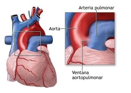 arteria pulmonar