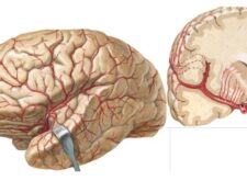 arteria cerebral media