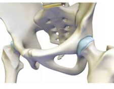 Articulación de la cadera