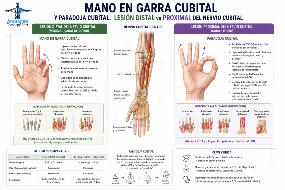 Músculos de la mano: intrínsecos, territorio nervioso y patología Mano en garra cubital y paradoja cubital: lesión distal vs proximal del nervio cubital